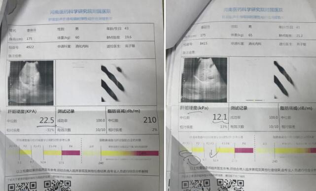 郑州肝病患者临床应用专利软肝术 成功逆转肝硬化
